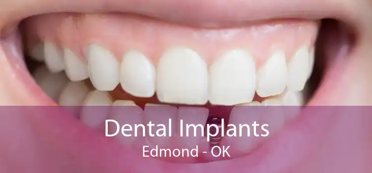 Dental Implants Edmond - OK