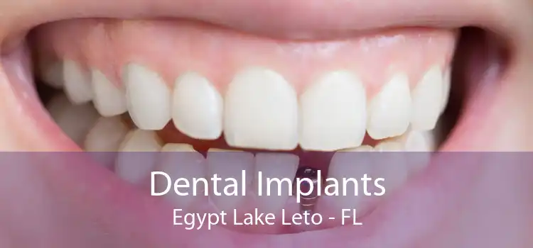 Dental Implants Egypt Lake Leto - FL