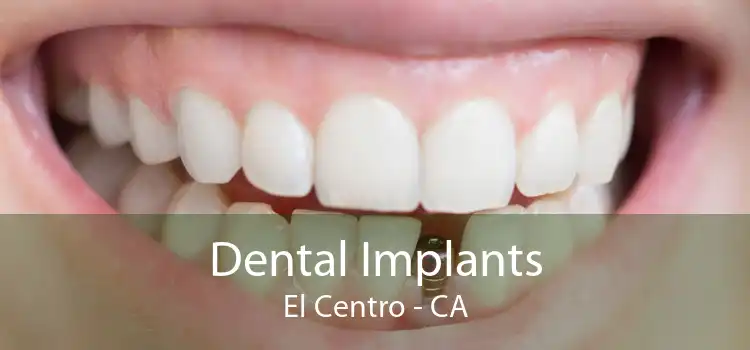 Dental Implants El Centro - CA