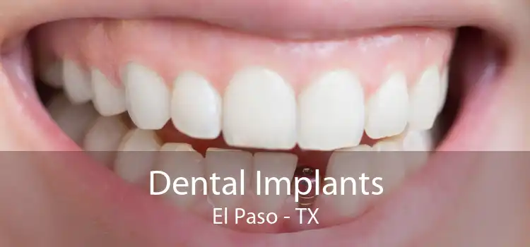Dental Implants El Paso - TX
