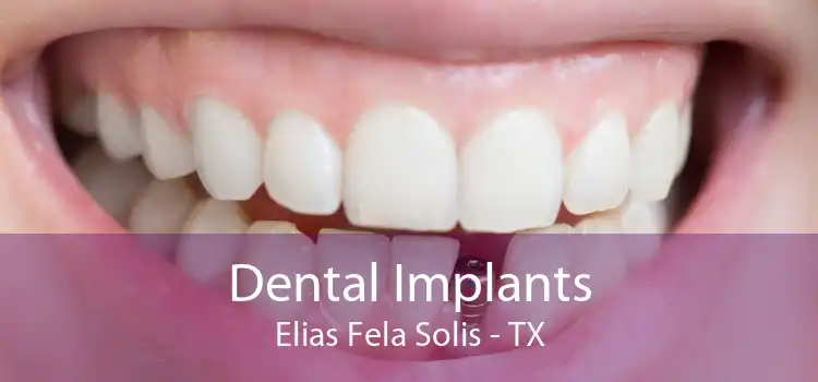 Dental Implants Elias Fela Solis - TX