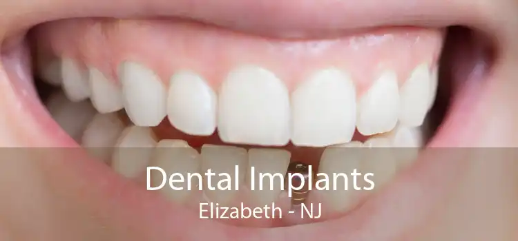 Dental Implants Elizabeth - NJ