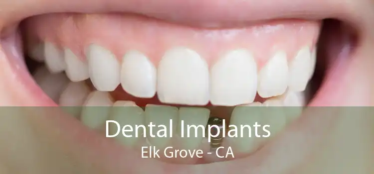 Dental Implants Elk Grove - CA