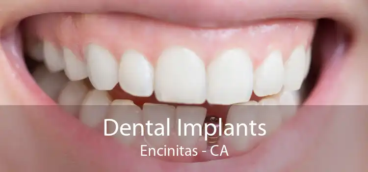 Dental Implants Encinitas - CA