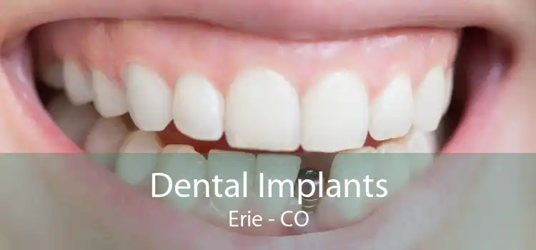 Dental Implants Erie - CO