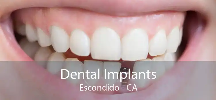 Dental Implants Escondido - CA