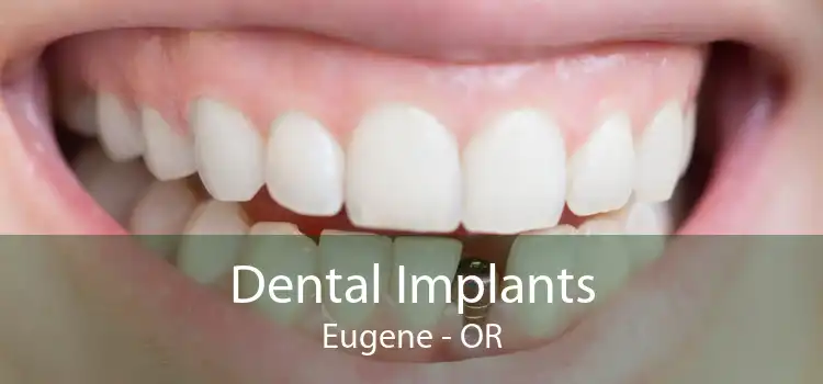 Dental Implants Eugene - OR