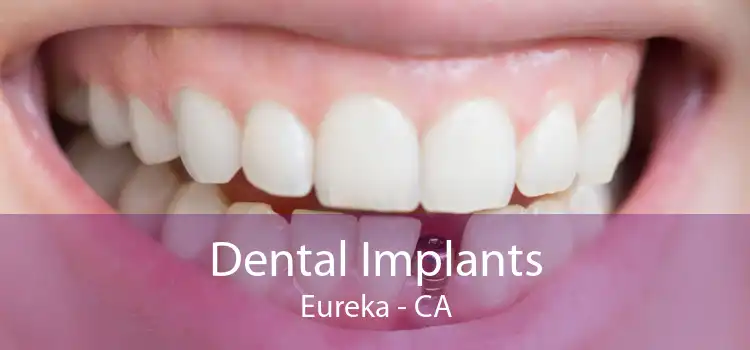 Dental Implants Eureka - CA