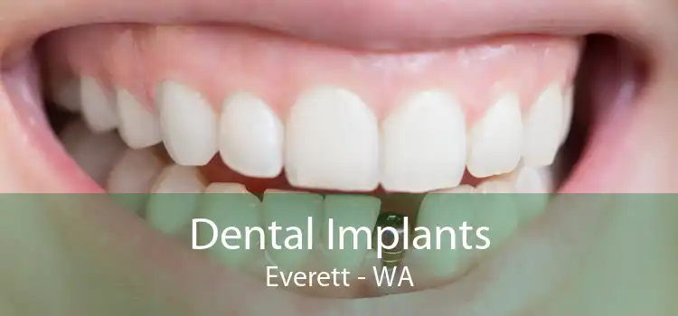 Dental Implants Everett - WA
