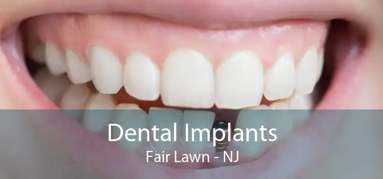Dental Implants Fair Lawn - NJ