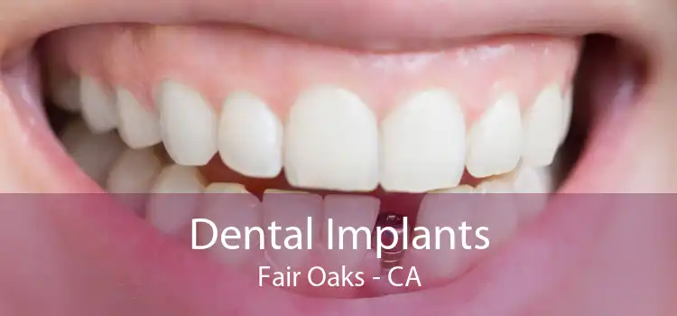 Dental Implants Fair Oaks - CA