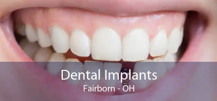 Dental Implants Fairborn - OH