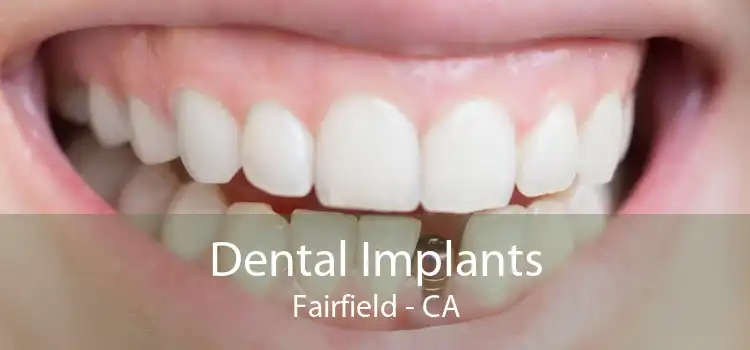 Dental Implants Fairfield - CA