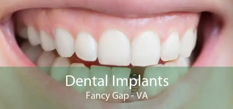 Dental Implants Fancy Gap - VA