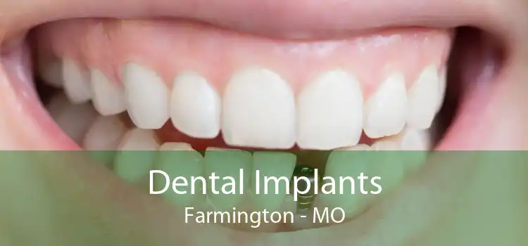 Dental Implants Farmington - MO