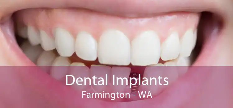 Dental Implants Farmington - WA