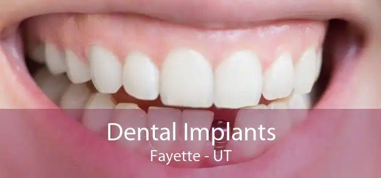 Dental Implants Fayette - UT