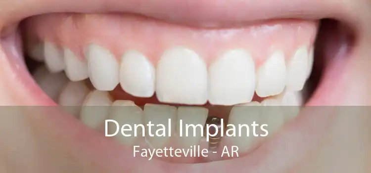 Dental Implants Fayetteville - AR