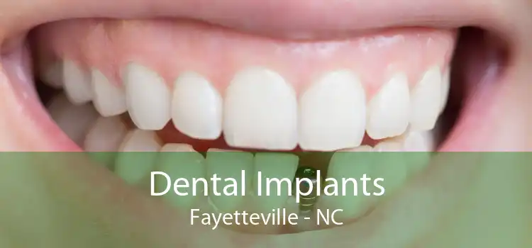 Dental Implants Fayetteville - NC