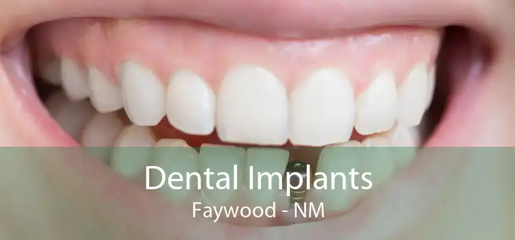 Dental Implants Faywood - NM
