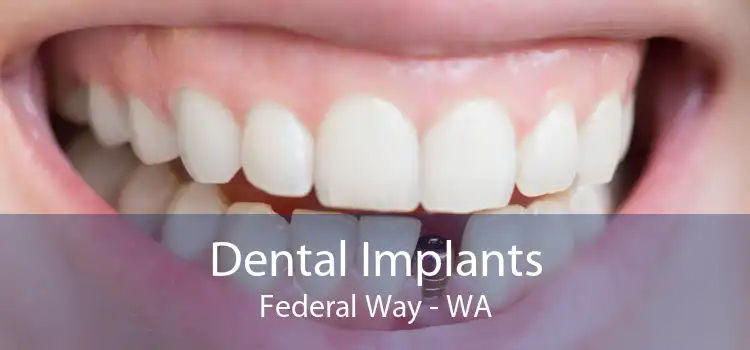 Dental Implants Federal Way - WA