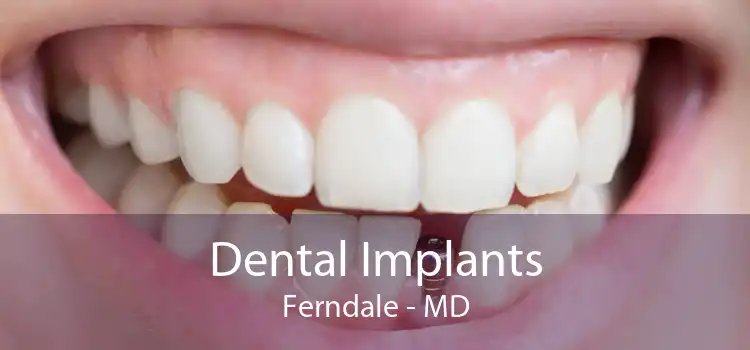 Dental Implants Ferndale - MD