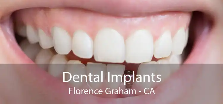 Dental Implants Florence Graham - CA