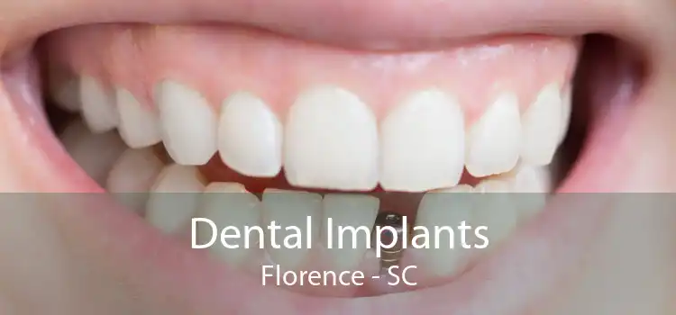Dental Implants Florence - SC