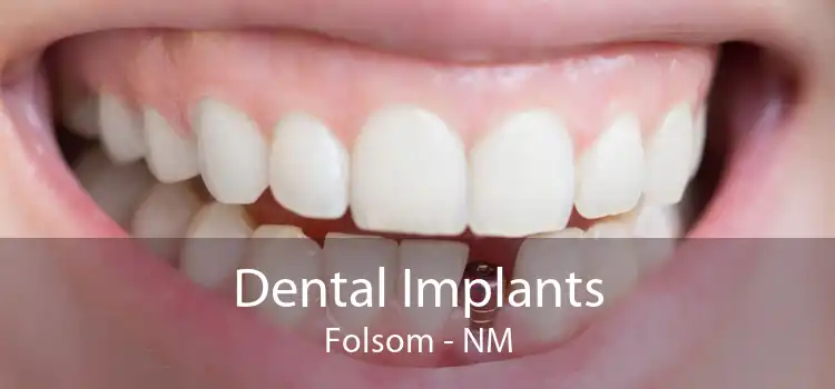 Dental Implants Folsom - NM