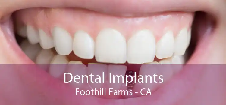 Dental Implants Foothill Farms - CA