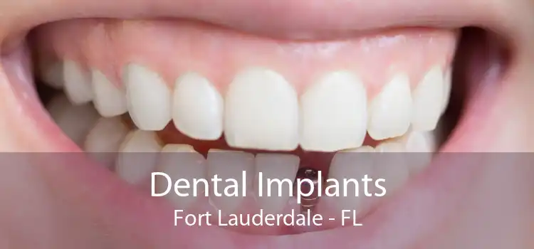 Dental Implants Fort Lauderdale - FL