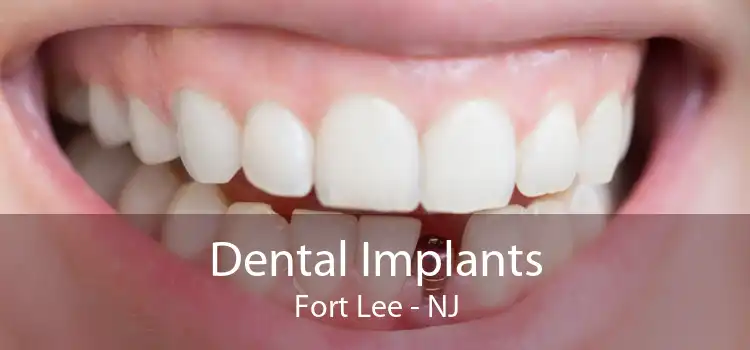 Dental Implants Fort Lee - NJ