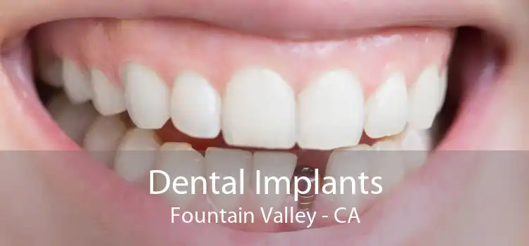 Dental Implants Fountain Valley - CA