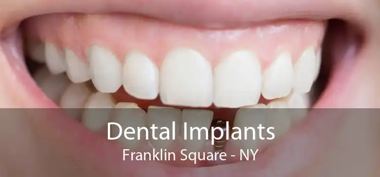 Dental Implants Franklin Square - NY
