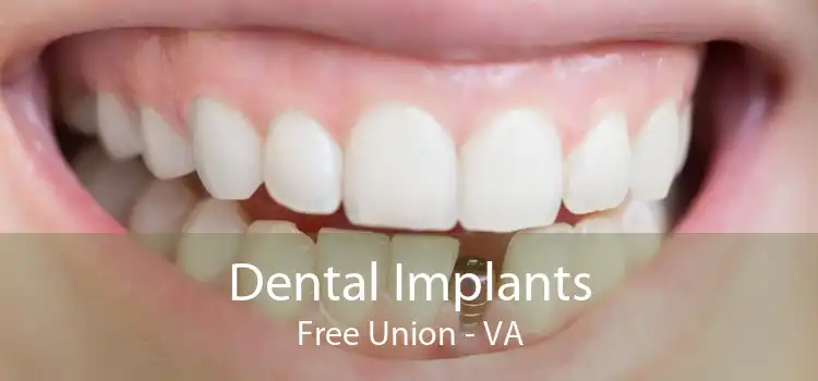 Dental Implants Free Union - VA