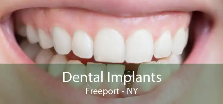 Dental Implants Freeport - NY