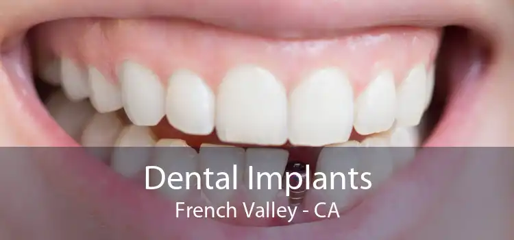 Dental Implants French Valley - CA