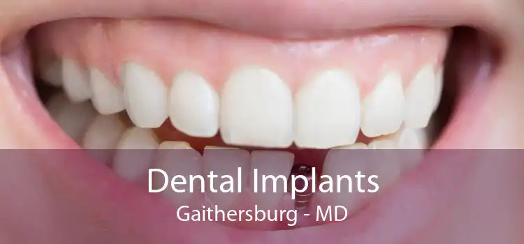 Dental Implants Gaithersburg - MD