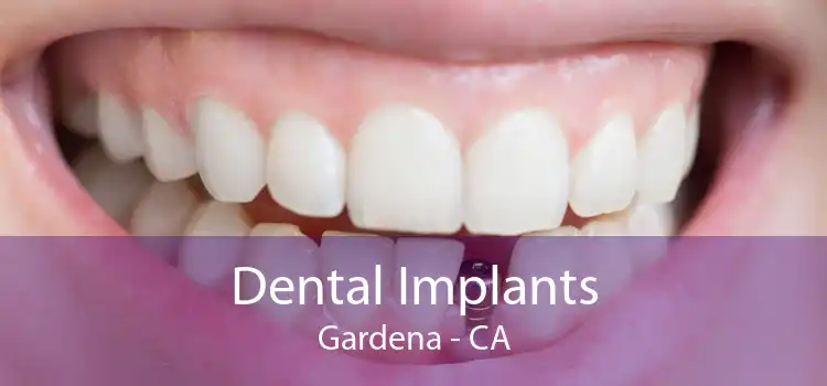 Dental Implants Gardena - CA
