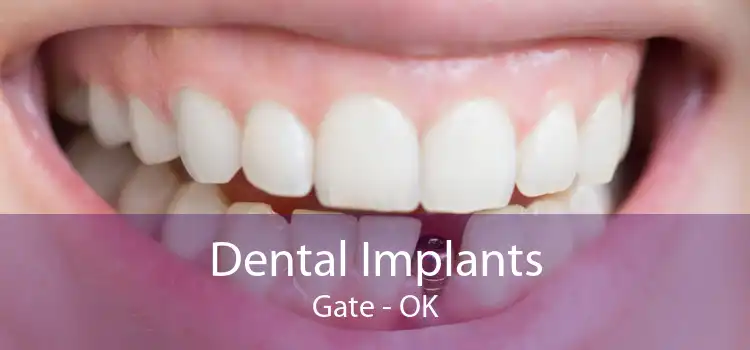 Dental Implants Gate - OK