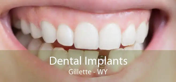 Dental Implants Gillette - WY