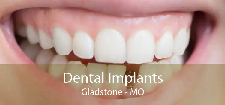 Dental Implants Gladstone - MO