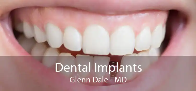 Dental Implants Glenn Dale - MD