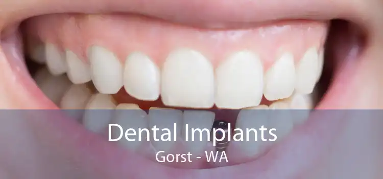 Dental Implants Gorst - WA