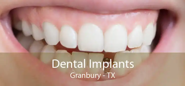 Dental Implants Granbury - TX