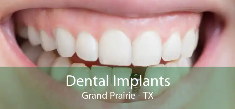 Dental Implants Grand Prairie - TX