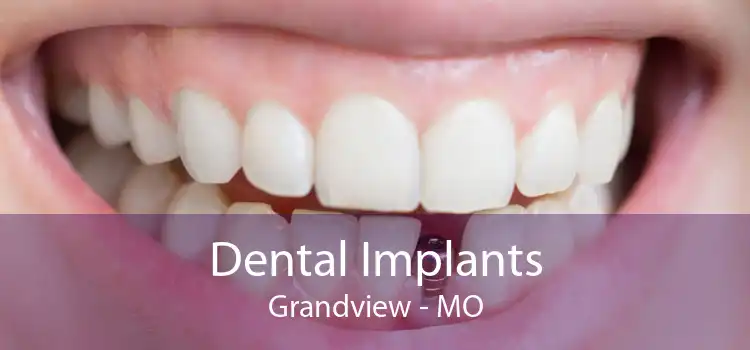 Dental Implants Grandview - MO