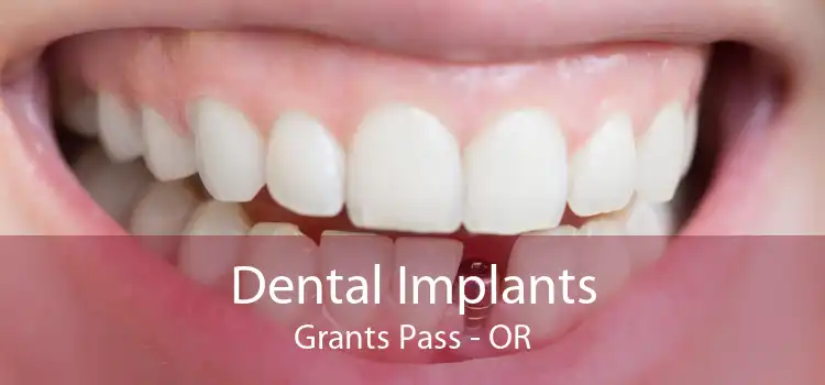 Dental Implants Grants Pass - OR
