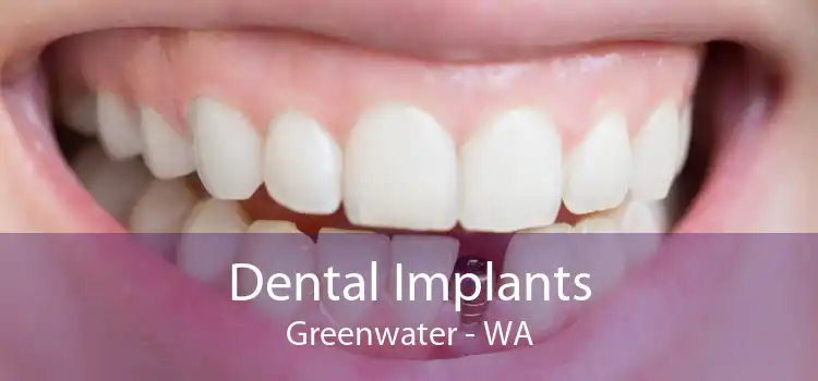 Dental Implants Greenwater - WA