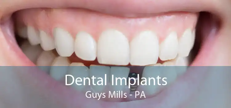 Dental Implants Guys Mills - PA